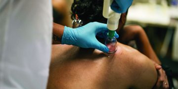 Top 5 Reasons to Try Cupping Therapy